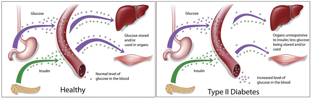 Two images comparing blood glucose regulation in a healthy person compared to a person with Type 2 diabetes. The healthy person has normal blood glucose levels because glucose is removed from the blood and stored in organs (liver, muscle). The person with Type 2 diabetes has increased blood glucose levels because organs are unresponsive to insulin so less glucose is removed from the blood and stored in organs (liver, muscle).