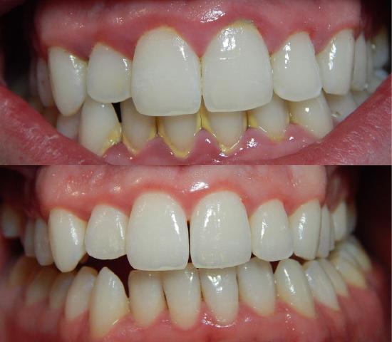 1024px-Gingivitis-before-and-after-3.jpg