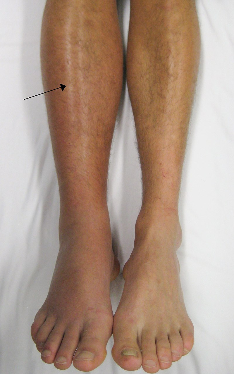 Photo showing signs of DVT on the right leg