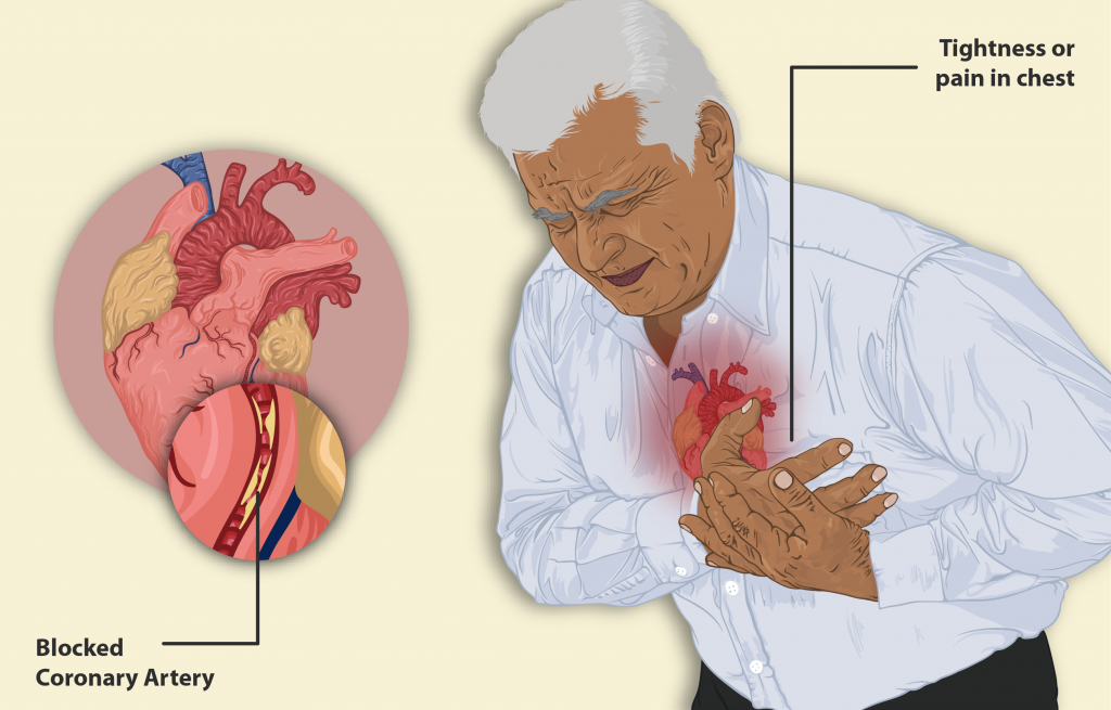 illustration of Man having a heart attack
