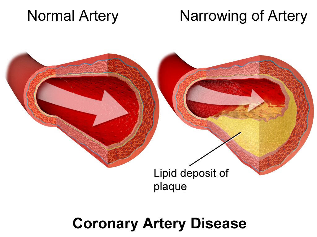 Drawing of a normal artery and a narrowing of an artery due to lipid deposit of plaque.