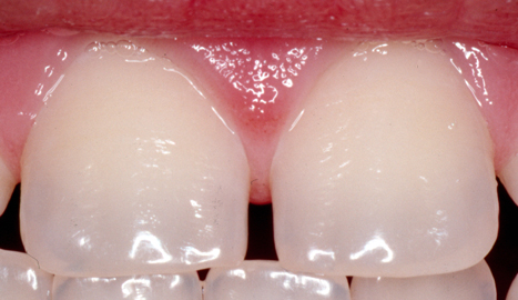 Fluorosis Progression: Image 1: normal teeth