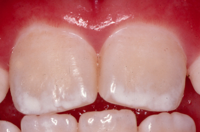 Fluorosis Progression: Image 2: mild fluorosis with a little discoloration of the teeth