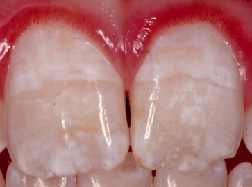 Fluorosis Progression: Image 3: moderate fluorosis with more significant discoloration of the teeth