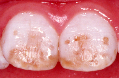 Fluorosis Progression: Image 4: severe fluorosis including pitted surfaces on the teeth