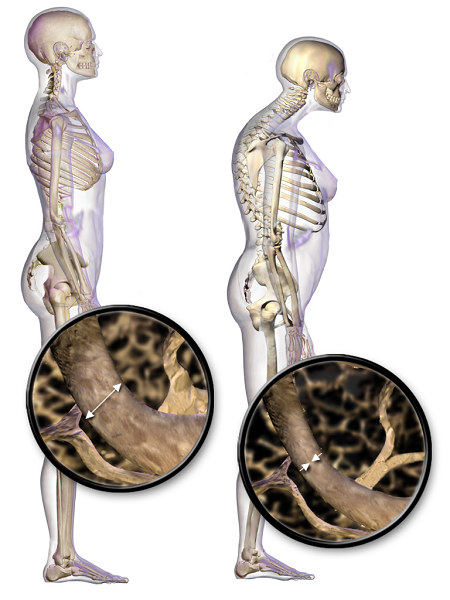Image of the vertebrae of a person with osteoporosis showing that the vertebrae are thinner and more collapsed than the vertebrae of a healthy person, in which the bone is more dense and uniform.