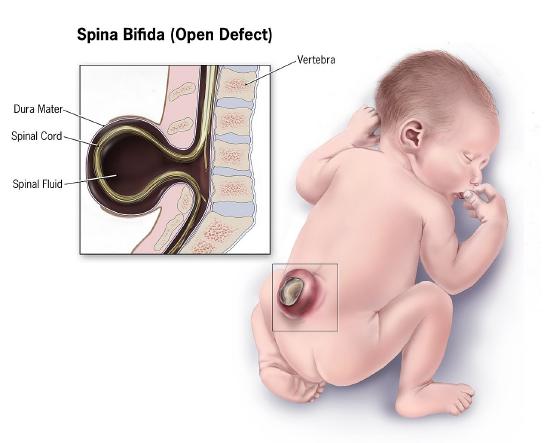 Drawing of an infant's spinal cord showing an open section of the spinal cord. This is known as spina bifida, a neural-tube defect that occurs when the spine does not completely enclose the spinal cord.