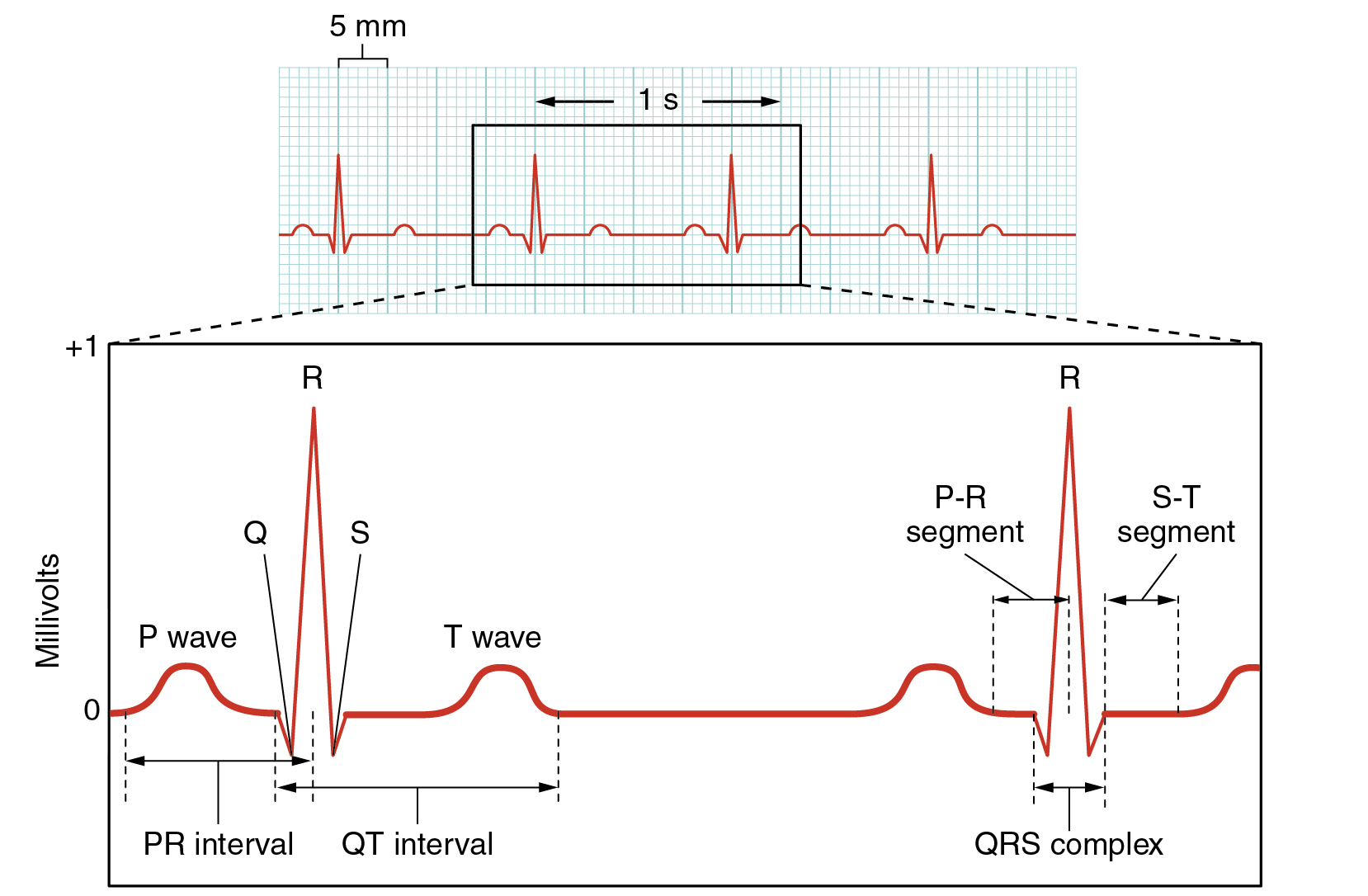 Electrocardiogram showing normal electrical activity (sinus rhythm) of the heart. 