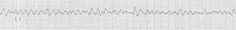 ECG is highly irregular with broad waves that vary in amplitude and shape. The ECG contains none of the features of a normal ECG.