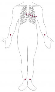 Standard Placement of ECG Leads.