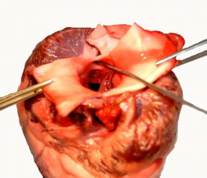 Probing of the entrance to the left coronary artery.