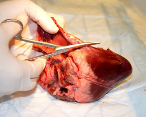 Cutting open the right ventricle.