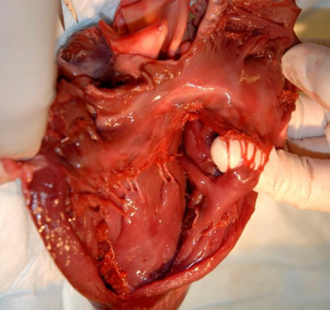 One of the cusps of the tricuspid valve, held up by a finger. Note the papillary muscle and chordae tendineae.