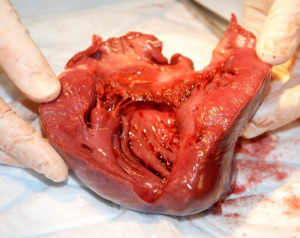 Left ventricle.