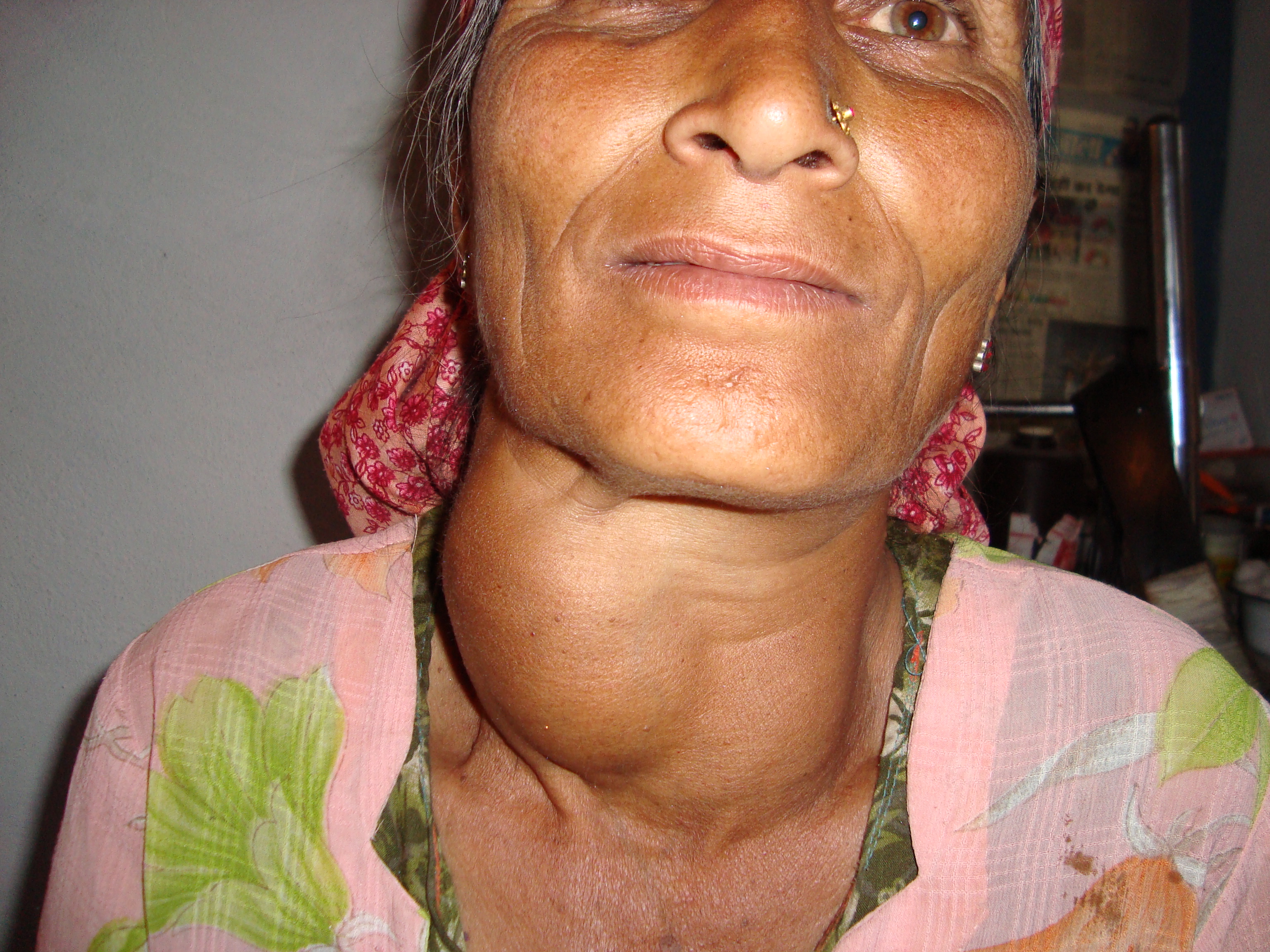 Picture of a woman with a goiter approximately the size of a grapefruit in the neck/thyroid area.