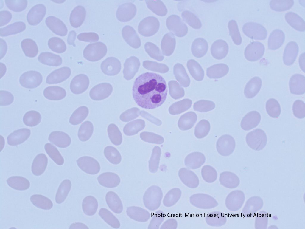 0238MarionsHereditaryElliptocytosis1-Gloria-Kwon-1024x768.jpg