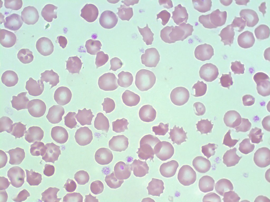 0318Acanthocytes-Gloria-Kwon-1024x768.jpg