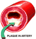 Side view of artery with plaque
