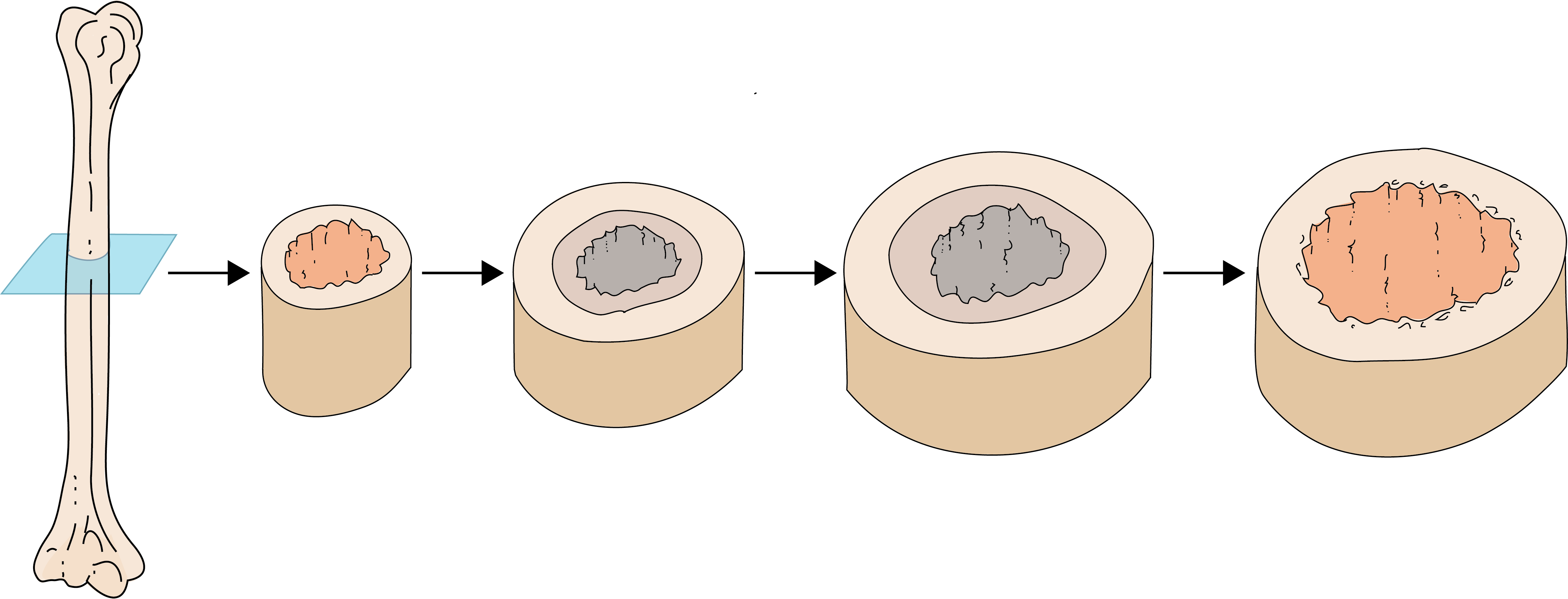 transverse section of bone growing in diameter over time