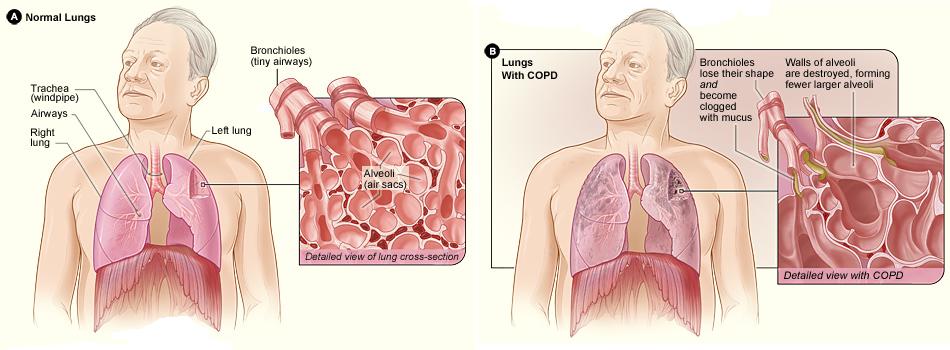 Normal alveoli are compared with those visible in a patient with COPD, in which alveolar walls are destroyed creating fewer, larger alveoli with reduced capability of gas exchange.