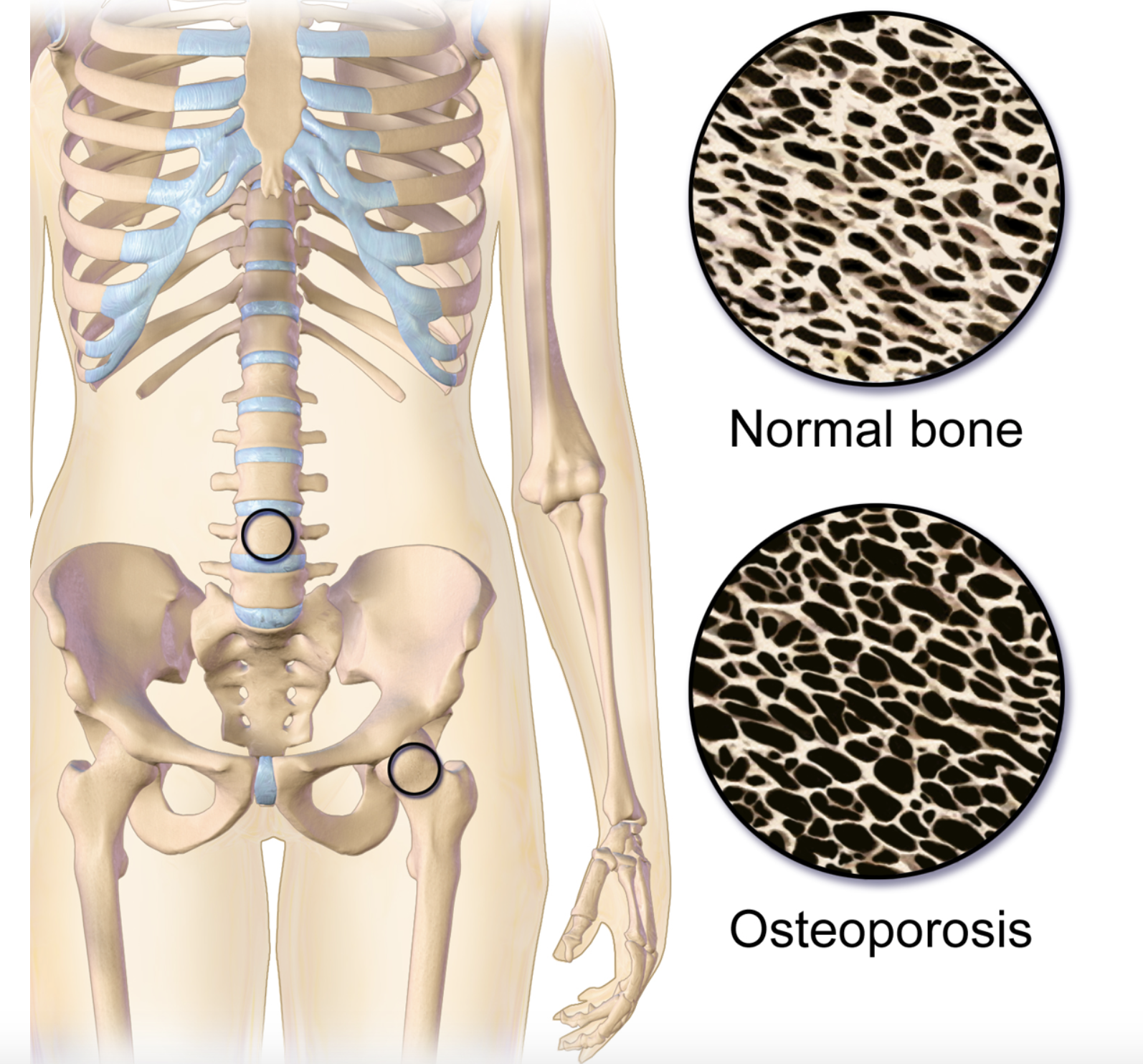 This is an animated image that shows the difference between the structure of normal bone which is less porous and bone with osteoporosis which is more porous.