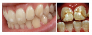 On the left is a close-up image of teeth with a mild case of fluorosis with small white spots forming on the teeth. A picture on the right shows a severe case of fluorosis in a close-up image of front teeth with significant white speckling, discoloration, and pitting.