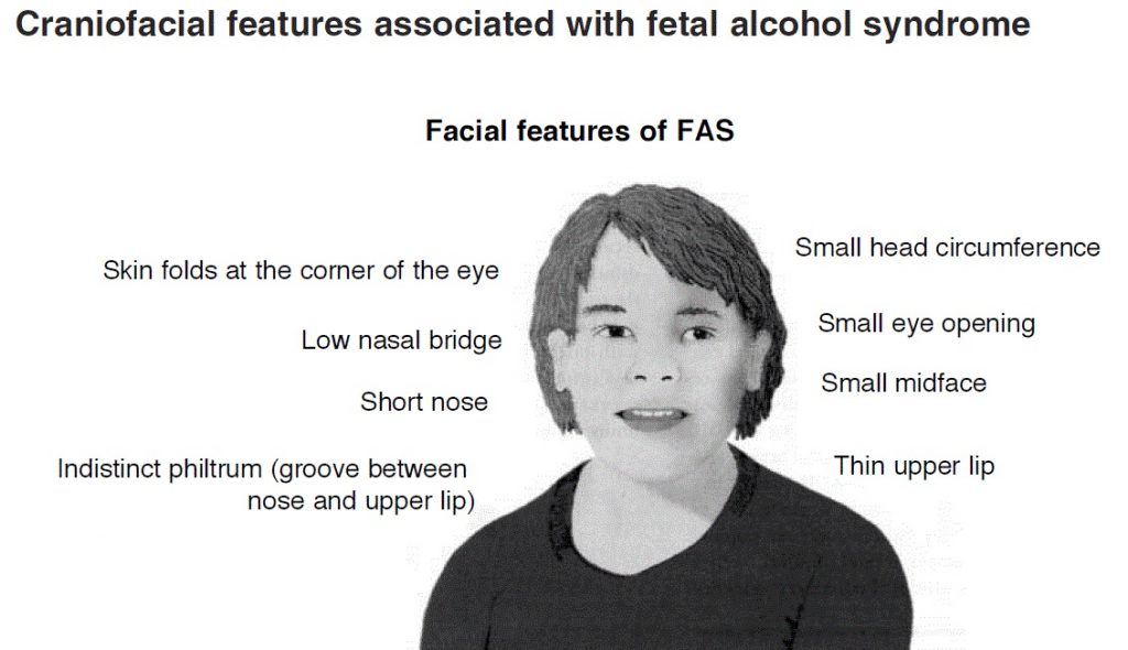 A black-and-white image depicting the facial features of fetal alcohol syndrome