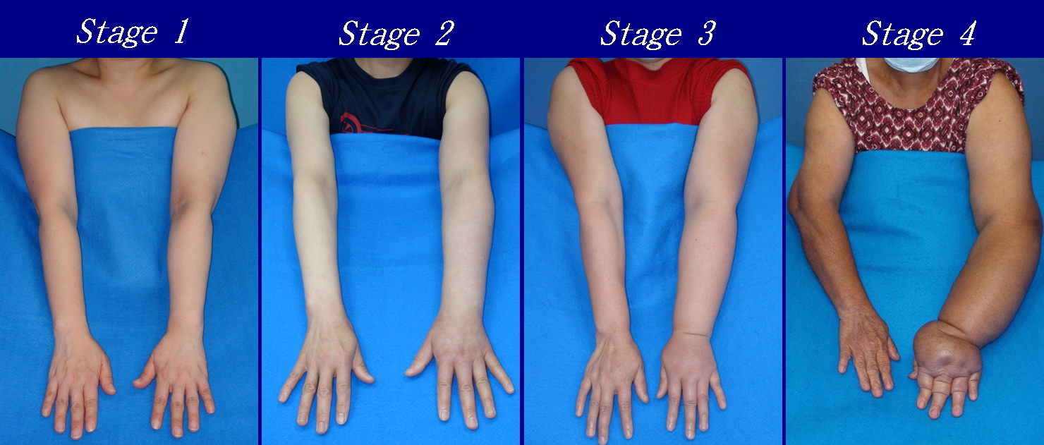 A comparison of the four stages of lymphedema in the left upper limb. Interstitial fluid builds up in an extremity if it is not returned to the bloodstream adequately by lymphatic vessels.