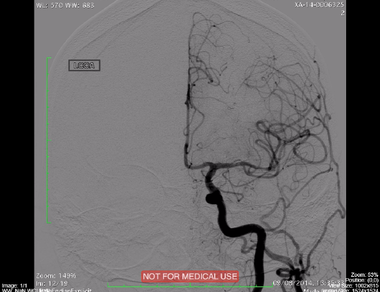carotid-angiography-DSA-e1506469676130.png