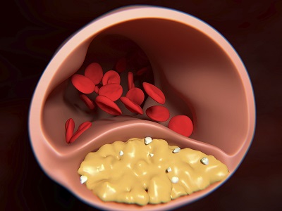 Coronary artery disease is caused by plaque buildup in the wall of the arteries that supply blood to the heart (called coronary arteries). Plaque is made up of cholesterol deposits. Plaque buildup causes the inside of the arteries to narrow over time. This process is called atherosclerosis.