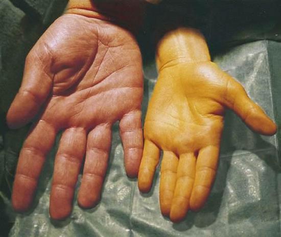 two hands, one with very yellow skin due to high levels of Carotenoids in the diet. 