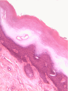 epitelio escamoso estratificado
