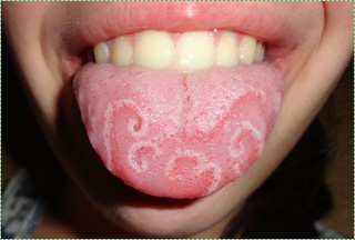 geographic tongue