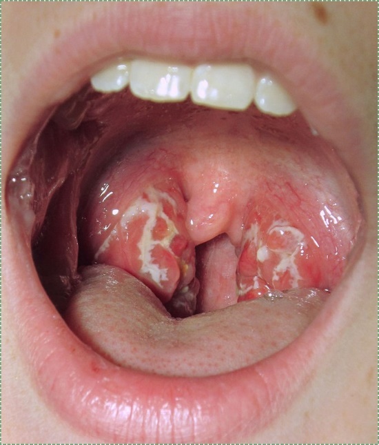 tonsils inflamed