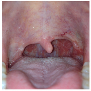 deviated uvula