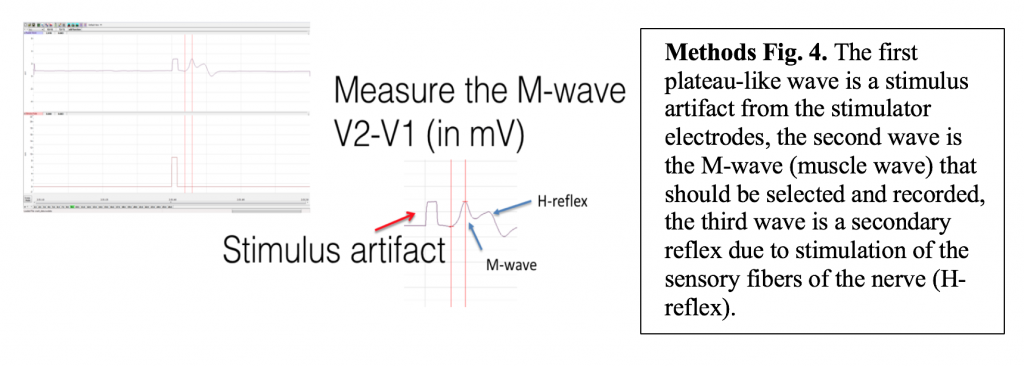 The first plateau-like wave is a stimulus artifact from the electrodes, the second is the M-wave that should be selected and recorded, the third wave is a secondary reflex due to the stimulation of the sensory fibers.