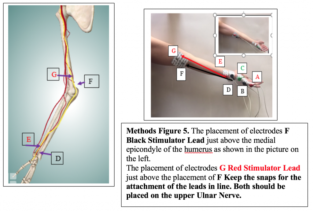 The placement of the electrodes F Black Stimulator Lead just above the medial epicondyle. The placement of electrodes G Red Stimulator Lead just above the placement of F.