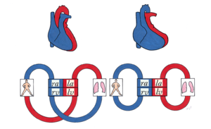300px-Figure_13._Schematic_drawing_of_the_circulation_in_transposition_of_the_great_arteries.png