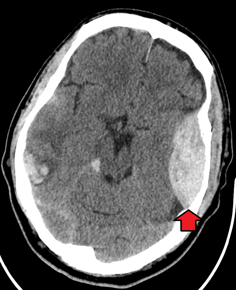 Image showing an epidural hematoma on the person's left with an associated skull fracture.