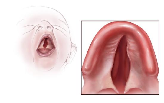 Illustration showing cleft palate in an infant