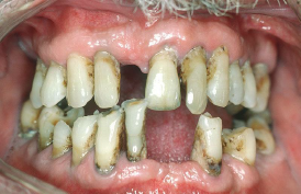 Photo showing periodontal disease progress in person's mouth