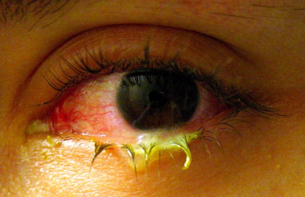 Foto mostrando primer plano de ojo infectado con conjuntivitis