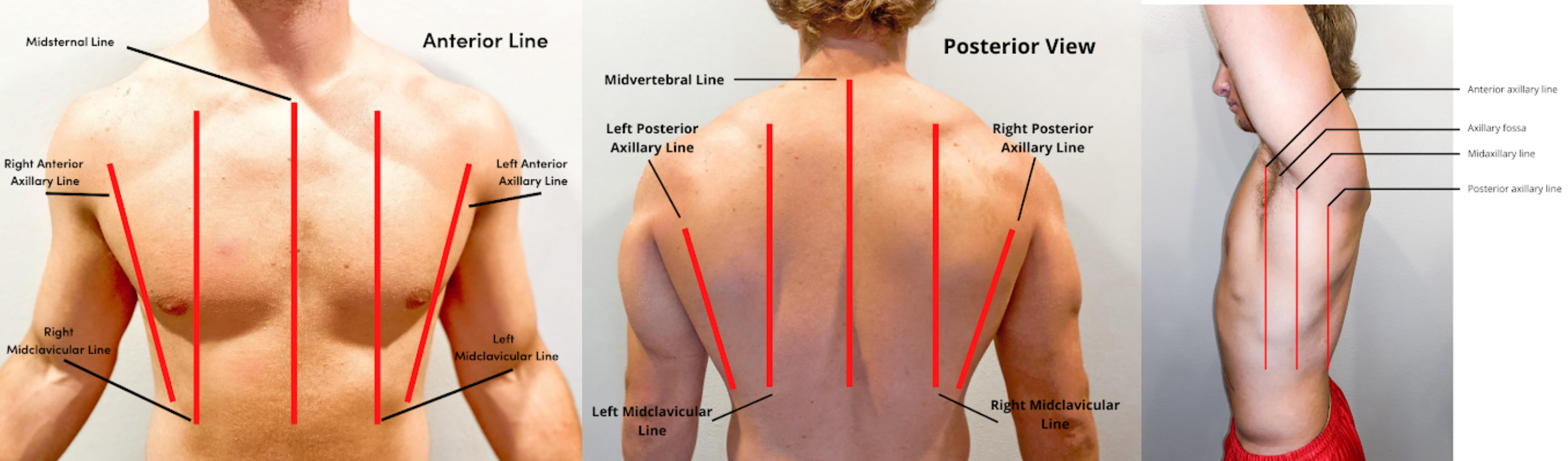 A practical treatise on medical diagnosis for students and physicians . The  flat or phthisical chest: short anteroposterior, long transverse diameter.  (Gee.) slanting, making the epigastric angle particularly sharp. The  shouldersfall;