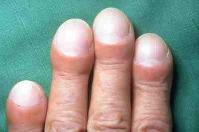 Photo showing clubbing of fingertips