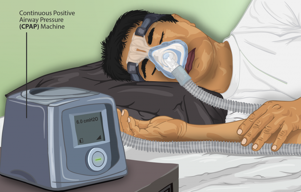 Illustration of person asleep on their side, while using a C-pap machine