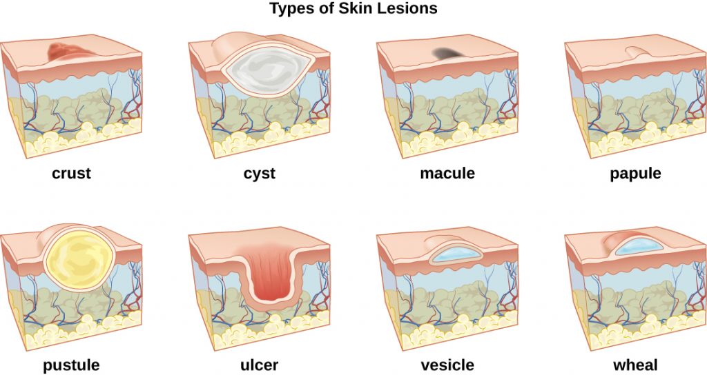 Illustration showing eight types of skin lesions
