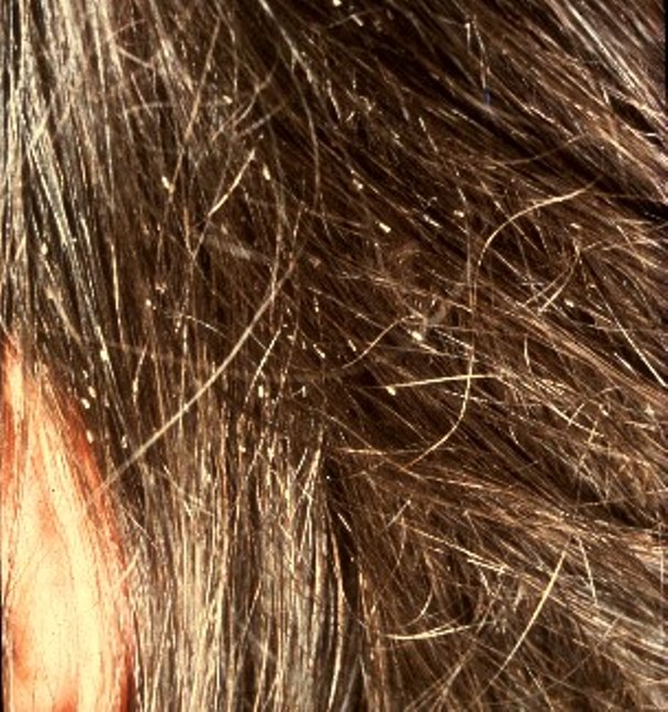Photo showing closeup of person's hair, containing lice nits