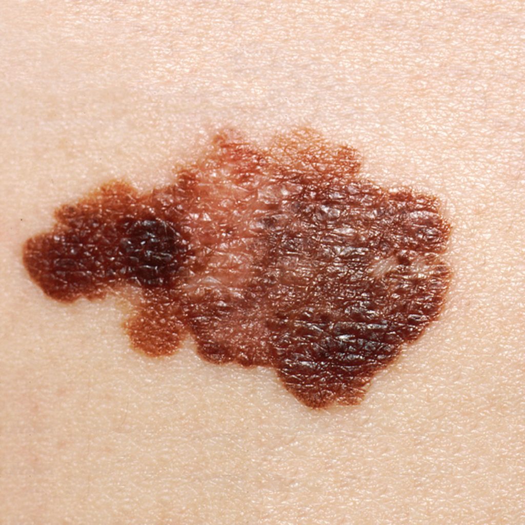 Photo showing closeup of melanoma on skin
