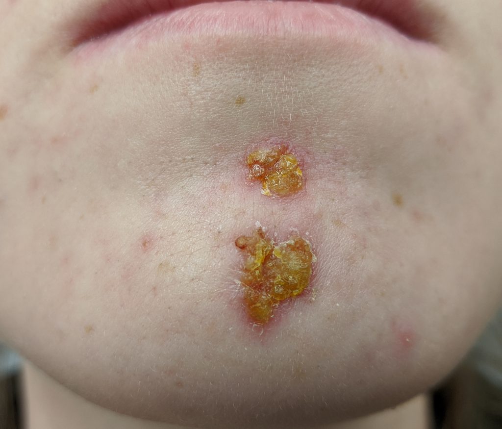 Photo showing closeup of chin area infected with impetigo