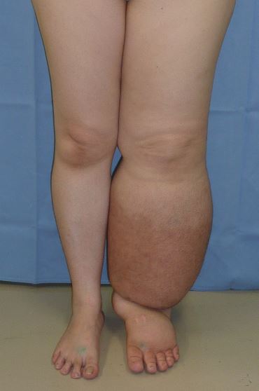 Foto que muestra linfedema en pierna izquierda de paciente